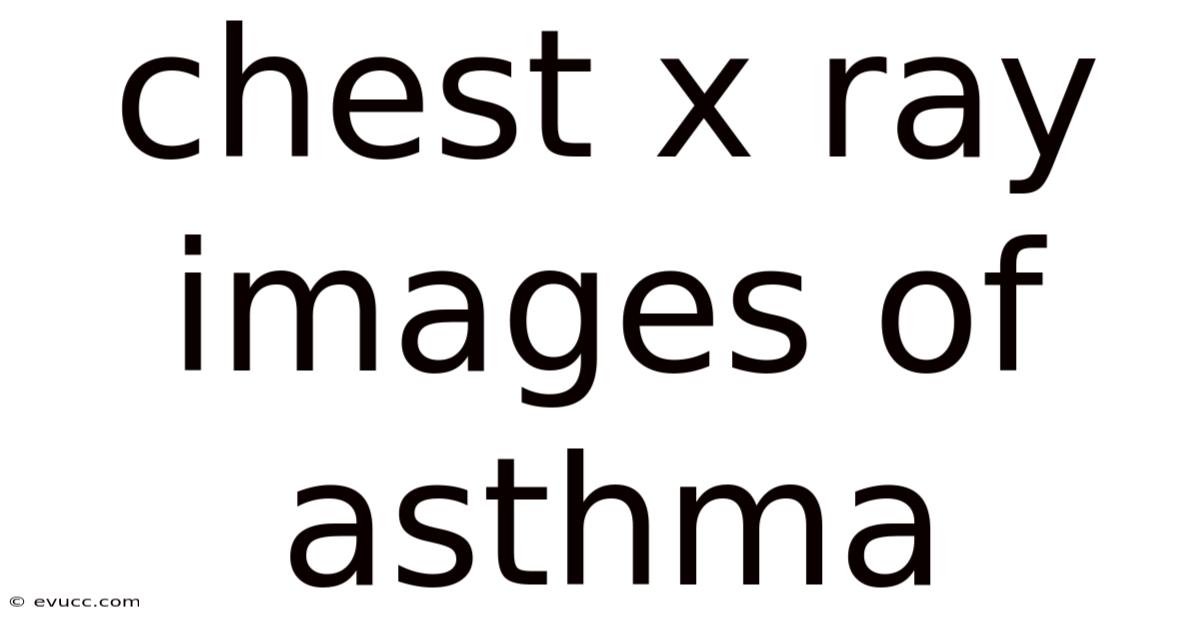 Chest X Ray Images Of Asthma