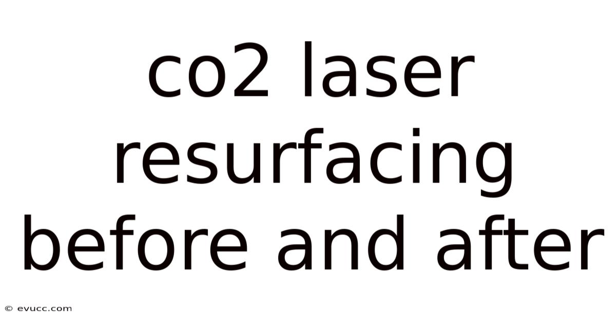 Co2 Laser Resurfacing Before And After