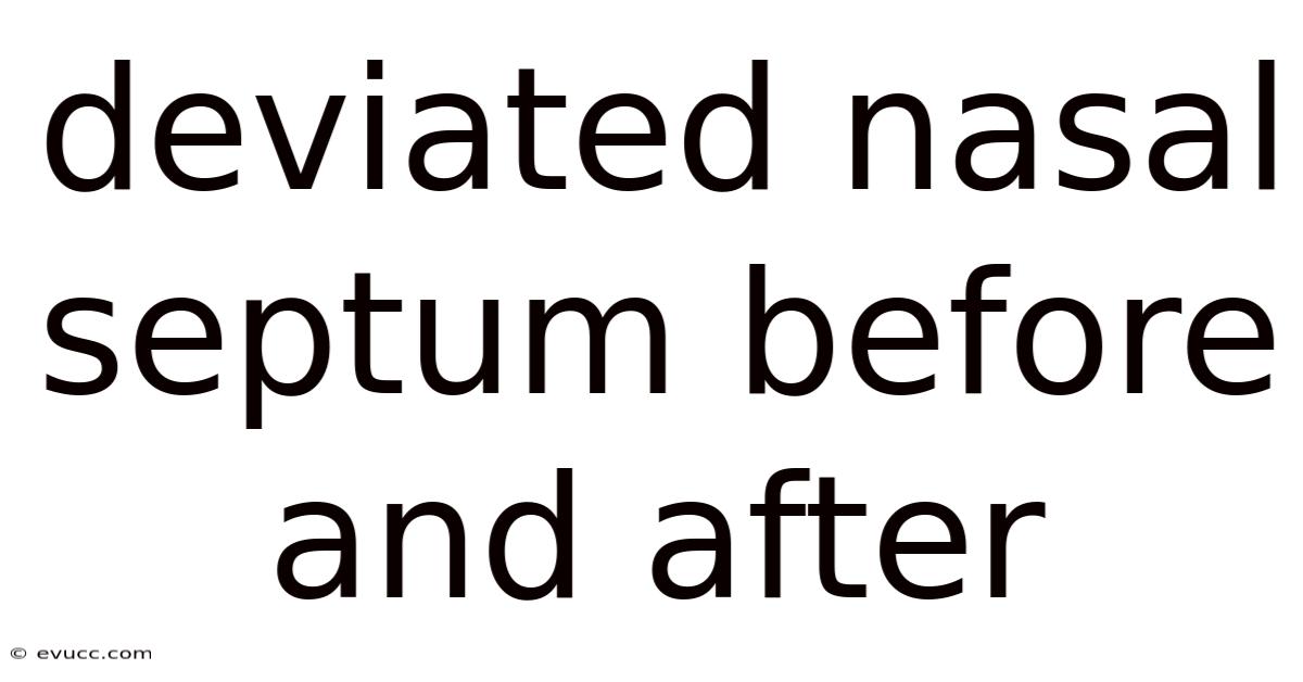 Deviated Nasal Septum Before And After