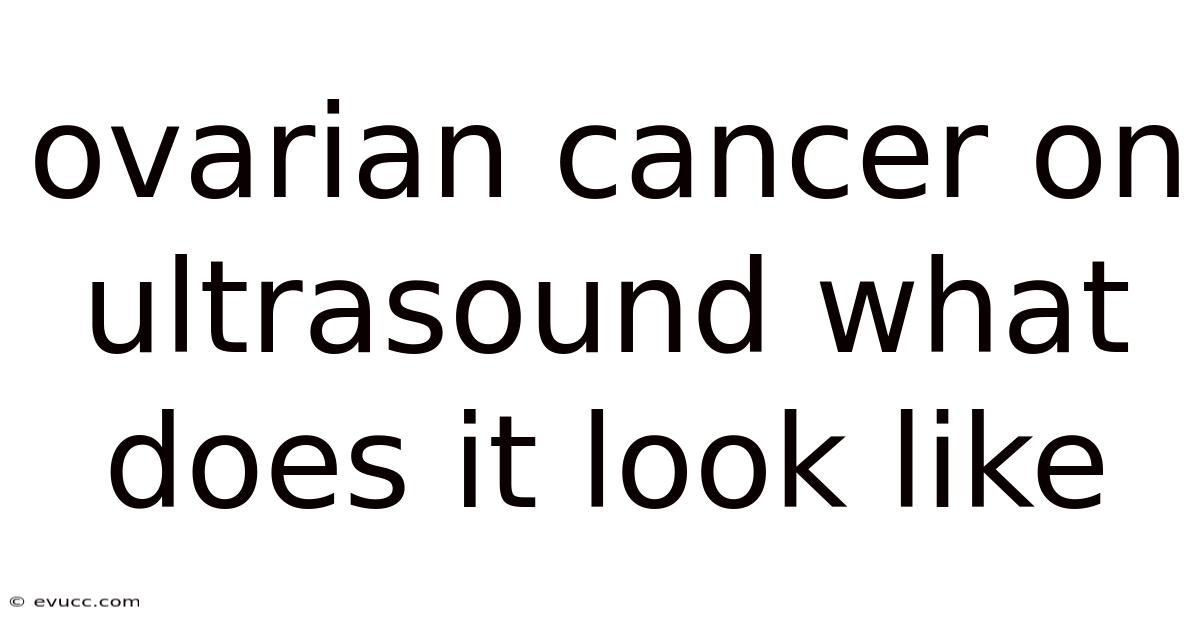 Ovarian Cancer On Ultrasound What Does It Look Like