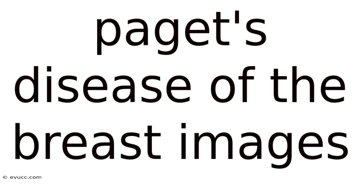 Paget's Disease Of The Breast Images