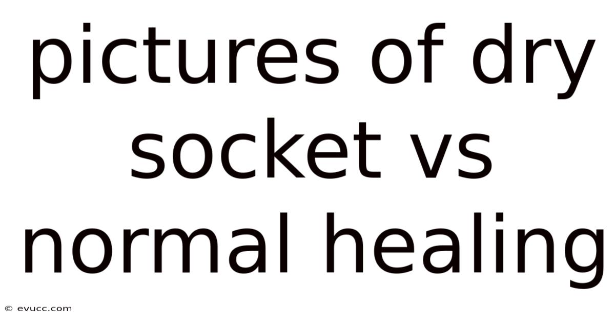 Pictures Of Dry Socket Vs Normal Healing