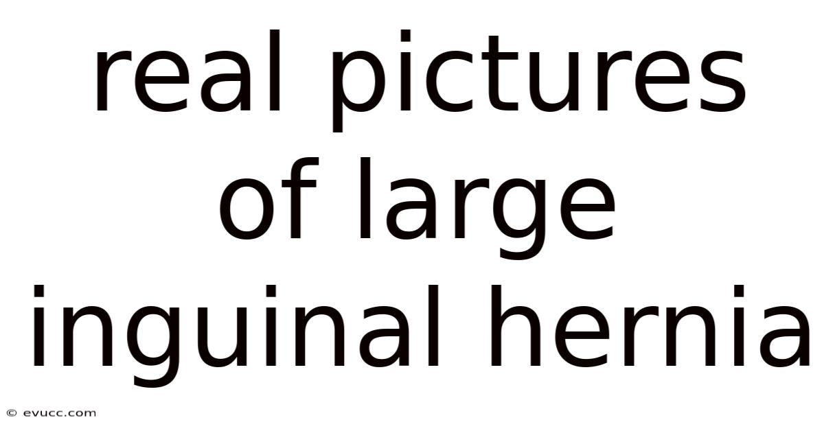 Real Pictures Of Large Inguinal Hernia