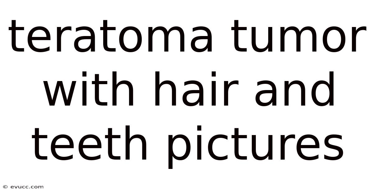 Teratoma Tumor With Hair And Teeth Pictures