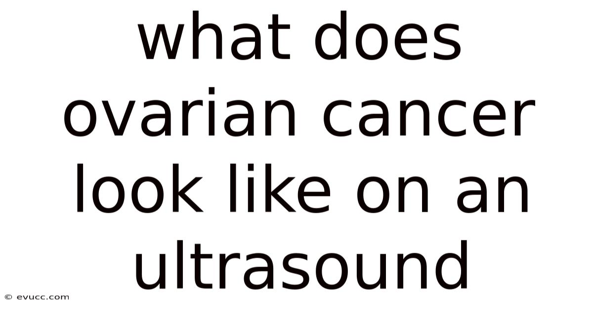 What Does Ovarian Cancer Look Like On An Ultrasound