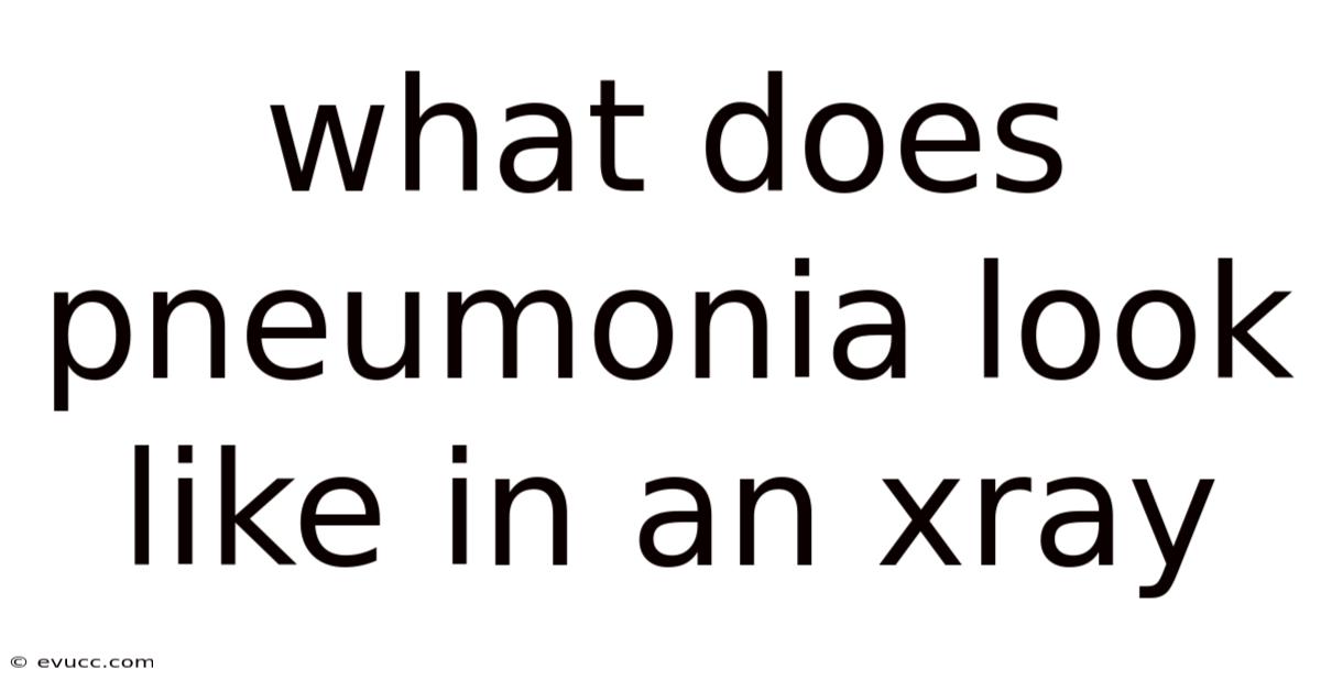 What Does Pneumonia Look Like In An Xray