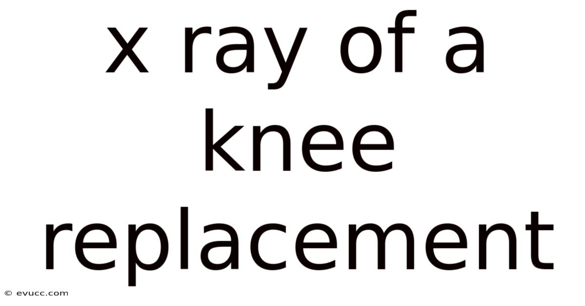 X Ray Of A Knee Replacement